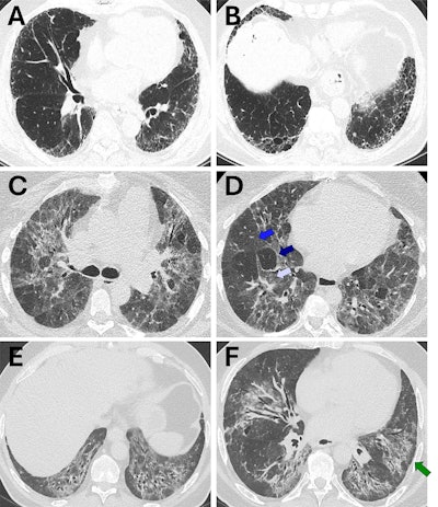 Look for disease distribution features to identify ILD patterns on CT
