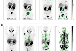 PSMA-PET images. (A) Representative examples illustrate the variability in the total tumor volume (TTV) among patients stratified by the number of metastatic lesions. (B) Case examples demonstrate TTV segmentation across a range of TTV values. Notably, as the tumor volume increased, a visible decrease in radiopharmaceutical uptake by normal organs is observed, particularly in the salivary glands, kidneys, and liver (denoted by brackets), a phenomenon known as the “sink effect.” SUV = standardized uptake value.