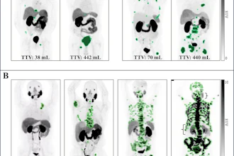 PSMA-PET images. (A) Representative examples illustrate the variability in the total tumor volume (TTV) among patients stratified by the number of metastatic lesions. (B) Case examples demonstrate TTV segmentation across a range of TTV values. Notably, as the tumor volume increased, a visible decrease in radiopharmaceutical uptake by normal organs is observed, particularly in the salivary glands, kidneys, and liver (denoted by brackets), a phenomenon known as the “sink effect.” SUV = standardized uptake value.
