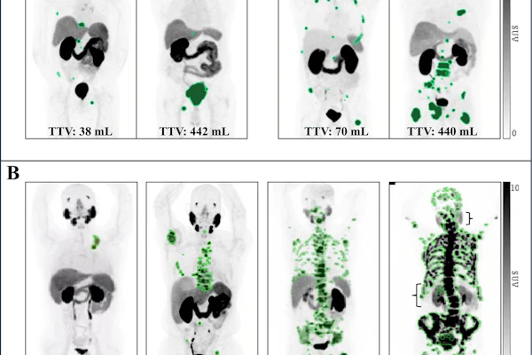 PSMA-PET images. (A) Representative examples illustrate the variability in the total tumor volume (TTV) among patients stratified by the number of metastatic lesions. (B) Case examples demonstrate TTV segmentation across a range of TTV values. Notably, as the tumor volume increased, a visible decrease in radiopharmaceutical uptake by normal organs is observed, particularly in the salivary glands, kidneys, and liver (denoted by brackets), a phenomenon known as the “sink effect.” SUV = standardized uptake value.