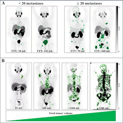 PET/CT metric improves outcome predictions in Pluvicto patients