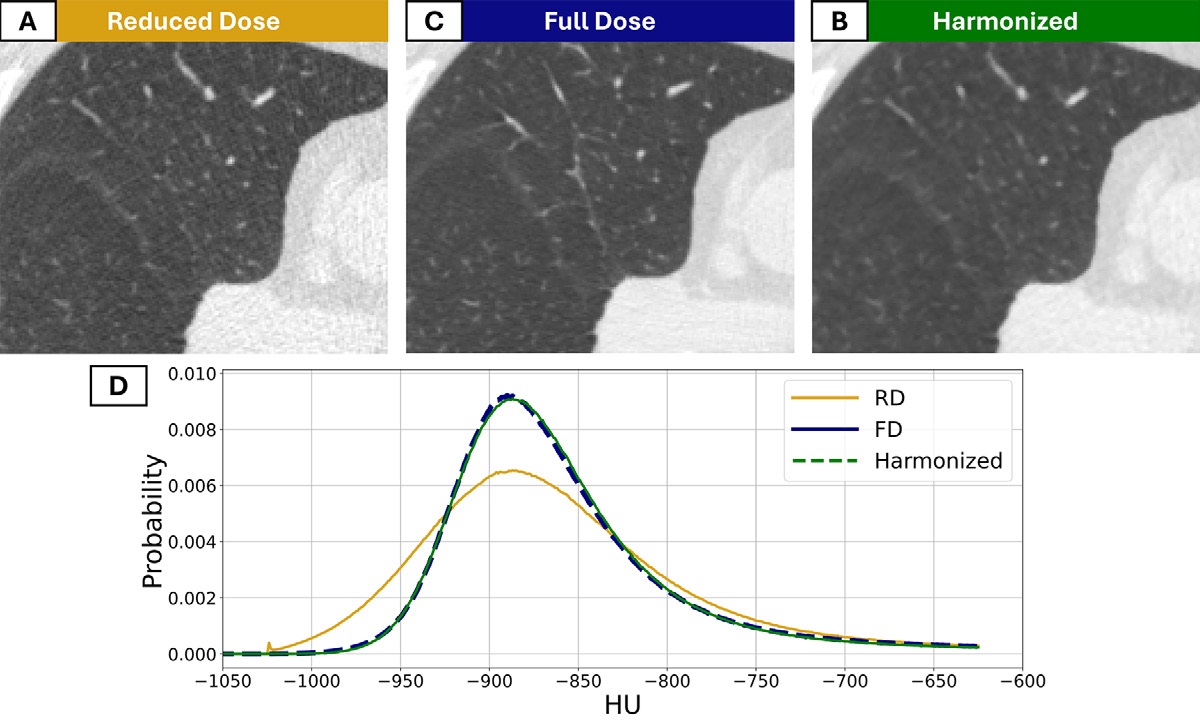 CT images in a 56-year-old man with preexisting mild centrilobular emphysema at baseline who currently smoked. (A) CT scan imaged with a reduced-dose (RD) acquisition protocol and (B) full-dose (FD) acquisition protocol. (C) The harmonized image obtained with the noise-adaptive median filtering technique. (D) Corresponding lung density histogram.