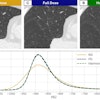 CT images in a 56-year-old man with preexisting mild centrilobular emphysema at baseline who currently smoked. (A) CT scan imaged with a reduced-dose (RD) acquisition protocol and (B) full-dose (FD) acquisition protocol. (C) The harmonized image obtained with the noise-adaptive median filtering technique. (D) Corresponding lung density histogram.