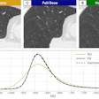CT images in a 56-year-old man with preexisting mild centrilobular emphysema at baseline who currently smoked. (A) CT scan imaged with a reduced-dose (RD) acquisition protocol and (B) full-dose (FD) acquisition protocol. (C) The harmonized image obtained with the noise-adaptive median filtering technique. (D) Corresponding lung density histogram.