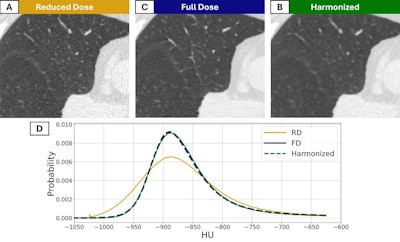 CT images in a 56-year-old man with preexisting mild centrilobular emphysema at baseline who currently smoked. (A) CT scan imaged with a reduced-dose (RD) acquisition protocol and (B) full-dose (FD) acquisition protocol. (C) The harmonized image obtained with the noise-adaptive median filtering technique. (D) Corresponding lung density histogram.