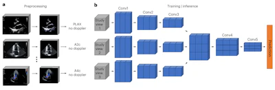 Deep learning improves disease detection on echo exams