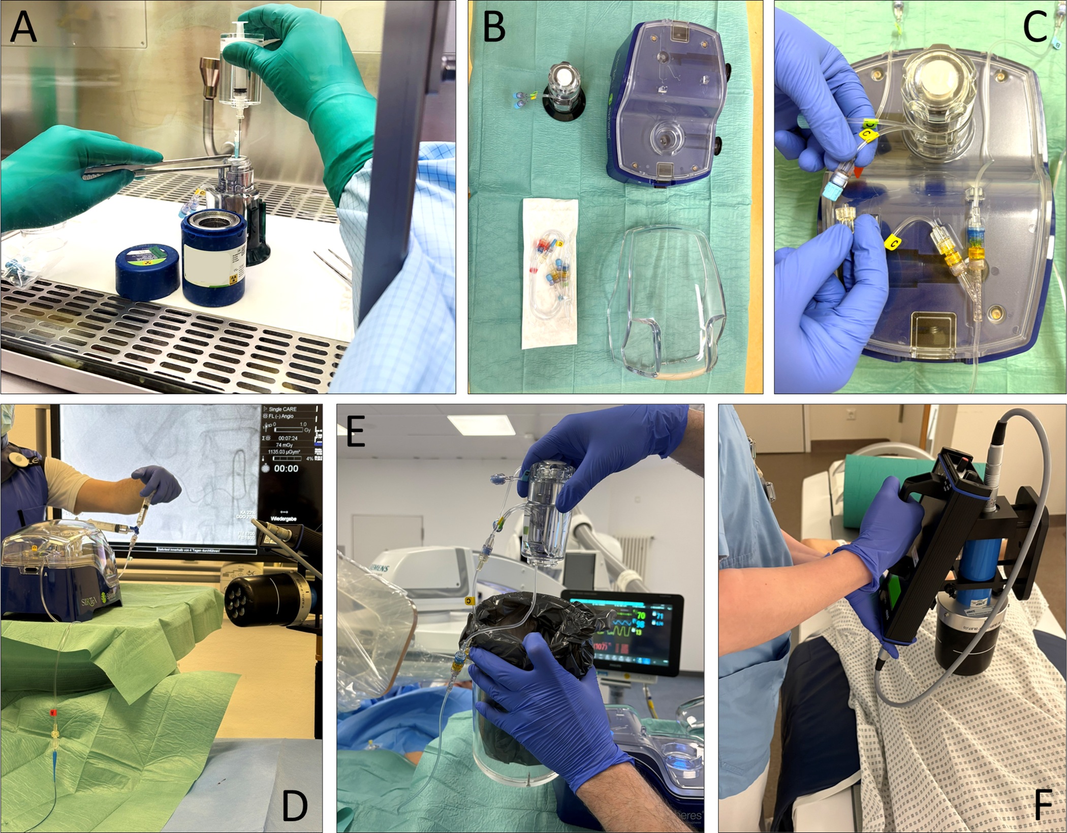 Photographs show an example of a Y-90 resin microsphere transarterial radioembolization (TARE) procedure using the generation 2 system. (A) Manual portioning by radiopharmacists of therapeutic radioactivity on a laminar flow bench meeting International Organization for Standardization class 5 cleanroom standards and equipped with lead shielding. (B) Single components of the application box. (C) Assembling by the medical physics expert of application box components and vials according to respective manuals. (D) Application box in angiography intervention room with application lines connected to the microcatheter while the nuclear medicine physician administers the microspheres. (E) Storage of empty vials and waste in an acrylic glass bin by the nuclear medicine physician. (F) Measurement of dose rates on the patient&rsquo;s liver surface immediately after TARE.