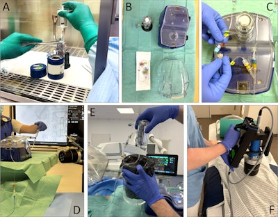 Photographs show an example of a Y-90 resin microsphere transarterial radioembolization (TARE) procedure using the generation 2 system. (A) Manual portioning by radiopharmacists of therapeutic radioactivity on a laminar flow bench meeting International Organization for Standardization class 5 cleanroom standards and equipped with lead shielding. (B) Single components of the application box. (C) Assembling by the medical physics expert of application box components and vials according to respective manuals. (D) Application box in angiography intervention room with application lines connected to the microcatheter while the nuclear medicine physician administers the microspheres. (E) Storage of empty vials and waste in an acrylic glass bin by the nuclear medicine physician. (F) Measurement of dose rates on the patient’s liver surface immediately after TARE.