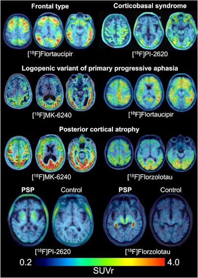 Examples of tau PET patterns in atypical AD and 4R tauopathies. Three axial slices upon MRI or MRI template show radiotracer distribution in exemplary cases of atypical AD and progressive supranuclear palsy (PSP).