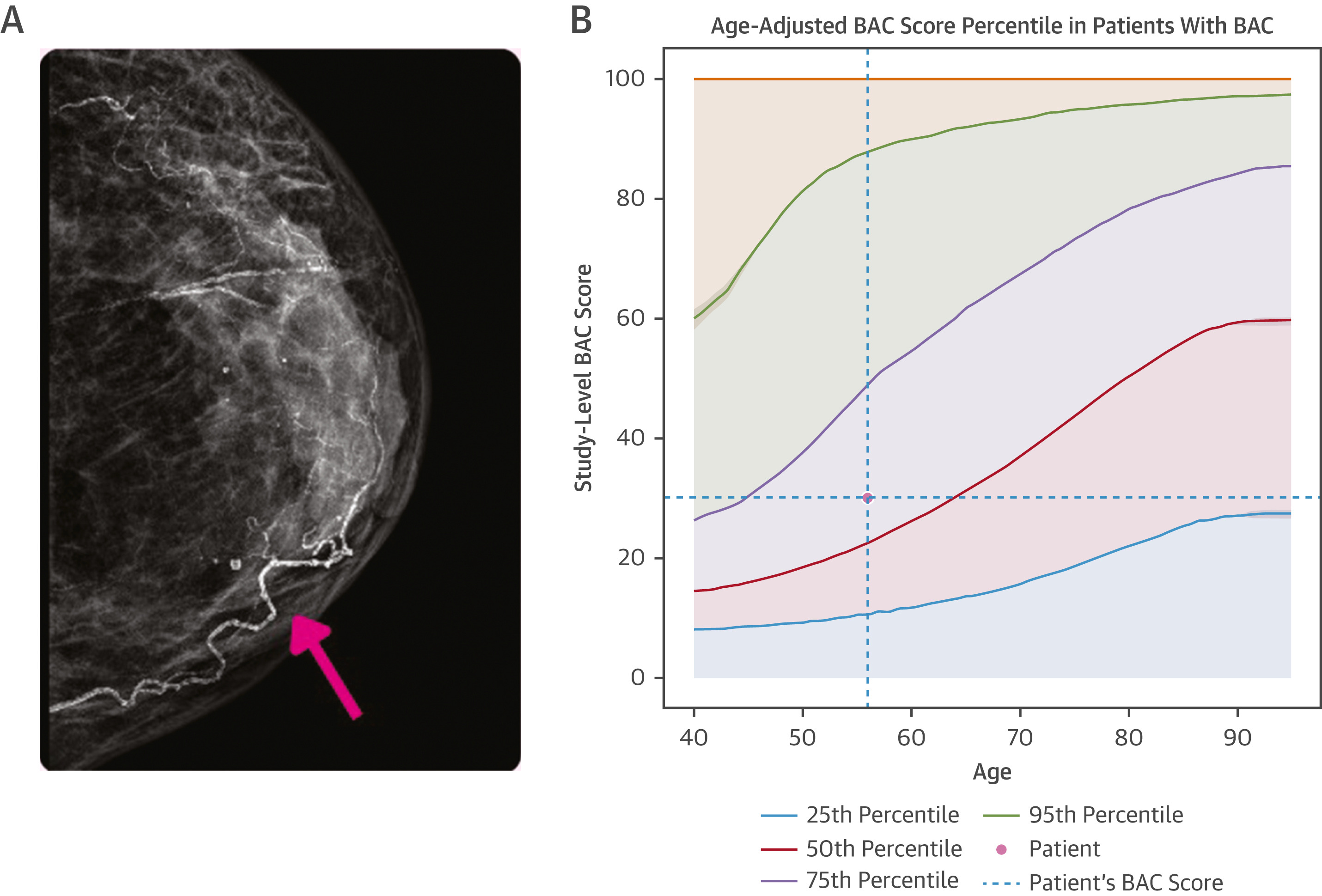 Example of Percentile Nomogram With Age-Adjusted BAC Quartiles. (A) Mammogram of a 56-year-old woman. There is evident BAC (pink arrow). This was quantified as a BAC score of 30 using the cmAngio tool. (B) Nomogram indicating that a BAC score of 30 places a 56-year-old woman within the 50th to 75th percentile for her age. Images are republished under a Creative Commons license (CC BY 4.0).