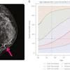 Example of Percentile Nomogram With Age-Adjusted BAC Quartiles. (A) Mammogram of a 56-year-old woman. There is evident BAC (pink arrow). This was quantified as a BAC score of 30 using the cmAngio tool. (B) Nomogram indicating that a BAC score of 30 places a 56-year-old woman within the 50th to 75th percentile for her age. Images are republished under a Creative Commons license (CC BY 4.0).