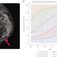 Example of Percentile Nomogram With Age-Adjusted BAC Quartiles. (A) Mammogram of a 56-year-old woman. There is evident BAC (pink arrow). This was quantified as a BAC score of 30 using the cmAngio tool. (B) Nomogram indicating that a BAC score of 30 places a 56-year-old woman within the 50th to 75th percentile for her age. Images are republished under a Creative Commons license (CC BY 4.0).