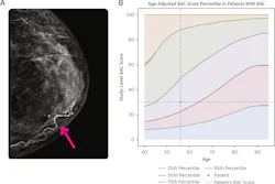 Example of Percentile Nomogram With Age-Adjusted BAC Quartiles. (A) Mammogram of a 56-year-old woman. There is evident BAC (pink arrow). This was quantified as a BAC score of 30 using the cmAngio tool. (B) Nomogram indicating that a BAC score of 30 places a 56-year-old woman within the 50th to 75th percentile for her age. Images are republished under a Creative Commons license (CC BY 4.0).
