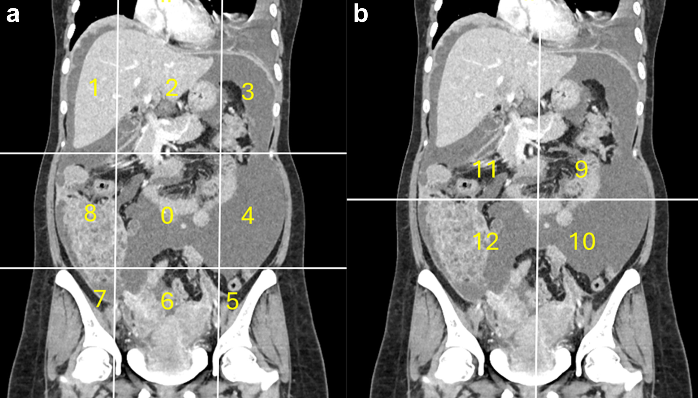 Calculation of radiological peritoneal cancer index (rPCI) adapted from Sugarbaker et al (1). (a) Coronal CT showing regions 0&ndash;8. Vertical lines are drawn along the right and left midclavicular line and the horizontal lines along the costal margin and the iliac crests. (b) Coronal CT showing regions 9 to 12. The vertical and the horizontal lines are through the umbilicus divide the small bowel and mesentery into proximal and distal jejunal and ileal regions. Images are republished under a Creative Commons license (CC BY 4.0).