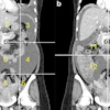 Calculation of radiological peritoneal cancer index (rPCI) adapted from Sugarbaker et al (1). (a) Coronal CT showing regions 0–8. Vertical lines are drawn along the right and left midclavicular line and the horizontal lines along the costal margin and the iliac crests. (b) Coronal CT showing regions 9 to 12. The vertical and the horizontal lines are through the umbilicus divide the small bowel and mesentery into proximal and distal jejunal and ileal regions. Images are republished under a Creative Commons license (CC BY 4.0).