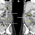 Calculation of radiological peritoneal cancer index (rPCI) adapted from Sugarbaker et al (1). (a) Coronal CT showing regions 0–8. Vertical lines are drawn along the right and left midclavicular line and the horizontal lines along the costal margin and the iliac crests. (b) Coronal CT showing regions 9 to 12. The vertical and the horizontal lines are through the umbilicus divide the small bowel and mesentery into proximal and distal jejunal and ileal regions. Images are republished under a Creative Commons license (CC BY 4.0).