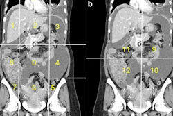 Calculation of radiological peritoneal cancer index (rPCI) adapted from Sugarbaker et al (1). (a) Coronal CT showing regions 0–8. Vertical lines are drawn along the right and left midclavicular line and the horizontal lines along the costal margin and the iliac crests. (b) Coronal CT showing regions 9 to 12. The vertical and the horizontal lines are through the umbilicus divide the small bowel and mesentery into proximal and distal jejunal and ileal regions. Images are republished under a Creative Commons license (CC BY 4.0).