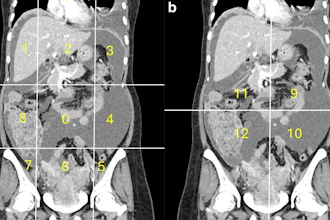 Calculation of radiological peritoneal cancer index (rPCI) adapted from Sugarbaker et al (1). (a) Coronal CT showing regions 0–8. Vertical lines are drawn along the right and left midclavicular line and the horizontal lines along the costal margin and the iliac crests. (b) Coronal CT showing regions 9 to 12. The vertical and the horizontal lines are through the umbilicus divide the small bowel and mesentery into proximal and distal jejunal and ileal regions. Images are republished under a Creative Commons license (CC BY 4.0).
