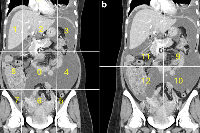 Calculation of radiological peritoneal cancer index (rPCI) adapted from Sugarbaker et al (1). (a) Coronal CT showing regions 0–8. Vertical lines are drawn along the right and left midclavicular line and the horizontal lines along the costal margin and the iliac crests. (b) Coronal CT showing regions 9 to 12. The vertical and the horizontal lines are through the umbilicus divide the small bowel and mesentery into proximal and distal jejunal and ileal regions. Images are republished under a Creative Commons license (CC BY 4.0).