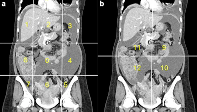 Calculation of radiological peritoneal cancer index (rPCI) adapted from Sugarbaker et al (1). (a) Coronal CT showing regions 0–8. Vertical lines are drawn along the right and left midclavicular line and the horizontal lines along the costal margin and the iliac crests. (b) Coronal CT showing regions 9 to 12. The vertical and the horizontal lines are through the umbilicus divide the small bowel and mesentery into proximal and distal jejunal and ileal regions. Images are republished under a Creative Commons license (CC BY 4.0).