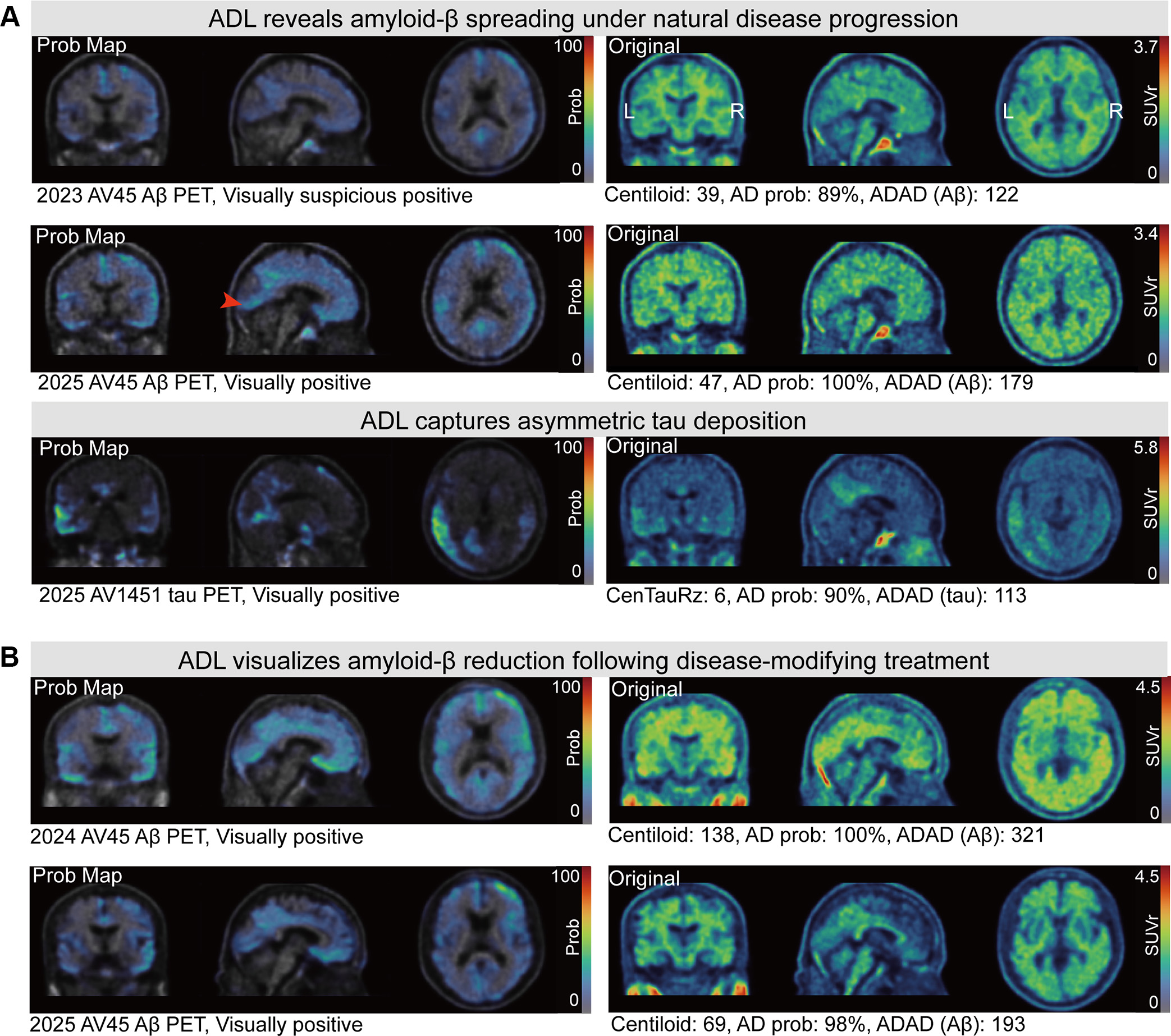 Adversarial decomposition learning (ADL) enables intuitive, longitudinal visualization of disease progression and treatment response, supporting clinician&ndash;artificial intelligence collaboration. (A) Images in a 48-year-old female patient who presented with mild cognitive impairment. The ADL probability maps highlighted occipital-temporal amyloid &beta; (A&beta;) spread and focal left-temporal tau pathologic abnormalities. An area of increased occipital AV45 uptake is shown (arrowhead). (B) Images in a 51-year-old male who presented with memory decline. For each image grid, the left side is the decoupler-output AD pathologic probability map, the upper right side is the original A&beta;/tau PET image, and the lower right side is the image after AD component removal by the decoupler.