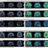 Adversarial decomposition learning (ADL) enables intuitive, longitudinal visualization of disease progression and treatment response, supporting clinician–artificial intelligence collaboration. (A) Images in a 48-year-old female patient who presented with mild cognitive impairment. The ADL probability maps highlighted occipital-temporal amyloid β (Aβ) spread and focal left-temporal tau pathologic abnormalities. An area of increased occipital AV45 uptake is shown (arrowhead). (B) Images in a 51-year-old male who presented with memory decline. For each image grid, the left side is the decoupler-output AD pathologic probability map, the upper right side is the original Aβ/tau PET image, and the lower right side is the image after AD component removal by the decoupler.