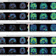Adversarial decomposition learning (ADL) enables intuitive, longitudinal visualization of disease progression and treatment response, supporting clinician–artificial intelligence collaboration. (A) Images in a 48-year-old female patient who presented with mild cognitive impairment. The ADL probability maps highlighted occipital-temporal amyloid β (Aβ) spread and focal left-temporal tau pathologic abnormalities. An area of increased occipital AV45 uptake is shown (arrowhead). (B) Images in a 51-year-old male who presented with memory decline. For each image grid, the left side is the decoupler-output AD pathologic probability map, the upper right side is the original Aβ/tau PET image, and the lower right side is the image after AD component removal by the decoupler.