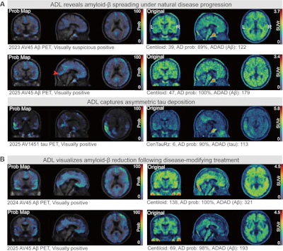 Adversarial decomposition learning (ADL) enables intuitive, longitudinal visualization of disease progression and treatment response, supporting clinician–artificial intelligence collaboration. (A) Images in a 48-year-old female patient who presented with mild cognitive impairment. The ADL probability maps highlighted occipital-temporal amyloid β (Aβ) spread and focal left-temporal tau pathologic abnormalities. An area of increased occipital AV45 uptake is shown (arrowhead). (B) Images in a 51-year-old male who presented with memory decline. For each image grid, the left side is the decoupler-output AD pathologic probability map, the upper right side is the original Aβ/tau PET image, and the lower right side is the image after AD component removal by the decoupler.