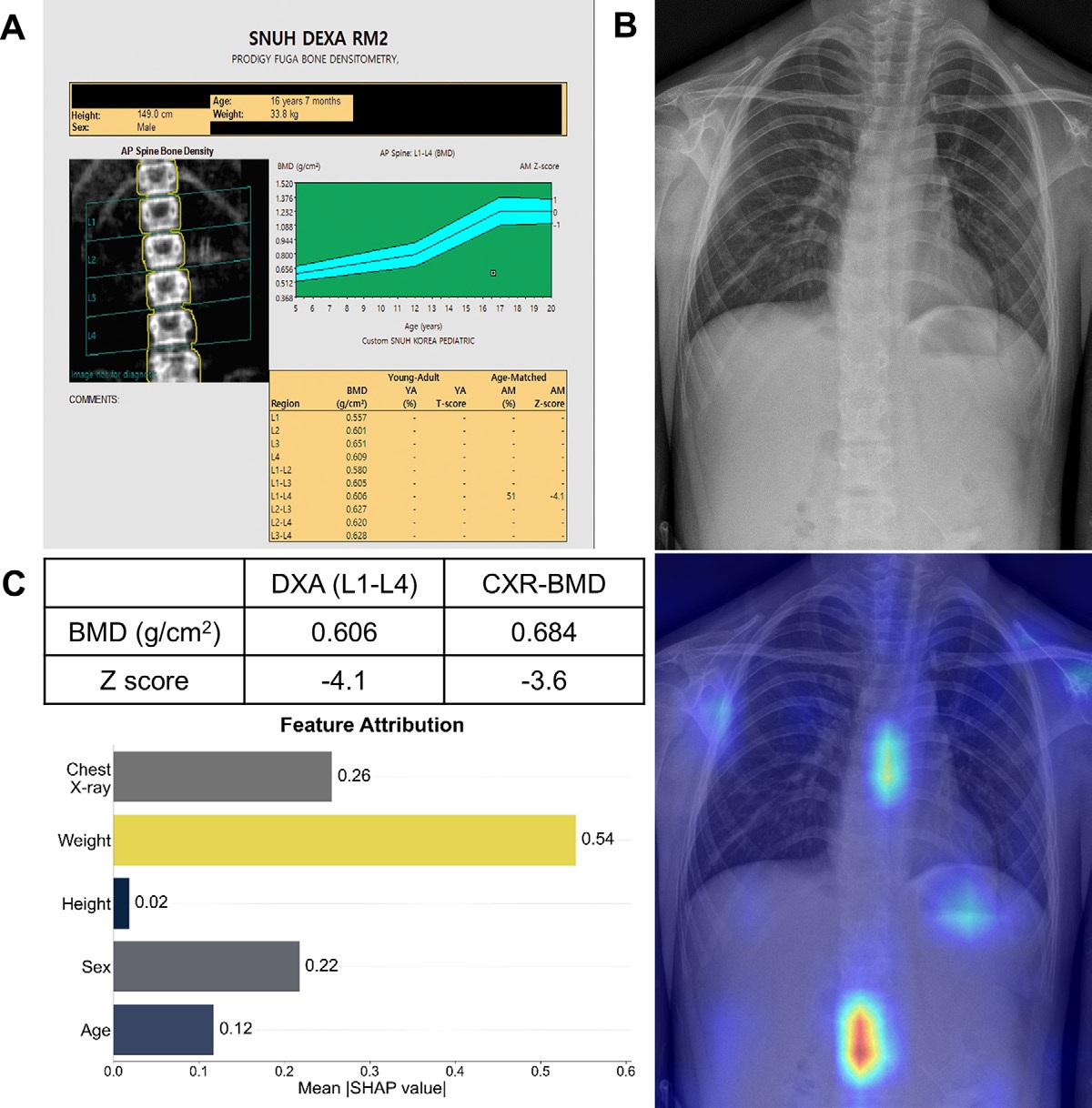 Representative example of a 16-year-old male patient with underlying X-linked adrenoleukodystrophy. (A, B) Paired anteroposterior (AP) chest radiograph and dual-energy x-ray absorptiometry (DXA) report shows lumbar spine (L1 through L4) areal bone mineral density (BMD). The DXA report was reformatted for anonymization and improved readability. The patient had low BMD (Z score &le; &minus;2.0). (C) Model (chest radiography [CXR]&ndash;BMD) output shows the predicted raw BMD and Z score in comparison with the DXA reference standard, together with interpretability analyses using Shapley additive explanations (SHAP) and gradient-weighted class activation maps. The patient was classified as having low BMD, consistent with the reference standard. AM = age-matched, DEXA = dual-energy x-ray absorptiometry, RM2 = room 2, SNUH = Seoul National University Hospital, YA = young adult.