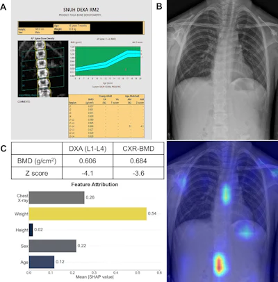 AI estimates children’s bone density on chest x-rays | AuntMinnie