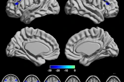 The PPD group showed significant increased VMHC in the dorsolateral prefrontal cortex (DLPFC), precentral gyrus (PreCG) and parietal lobule (PL) (FDR correction q-value < 0.005).