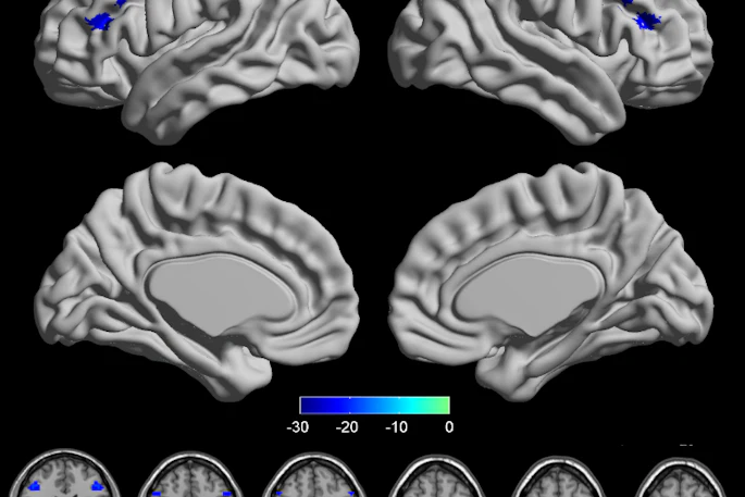 The PPD group showed significant increased VMHC in the dorsolateral prefrontal cortex (DLPFC), precentral gyrus (PreCG) and parietal lobule (PL) (FDR correction q-value < 0.005).