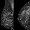 Breast Image
