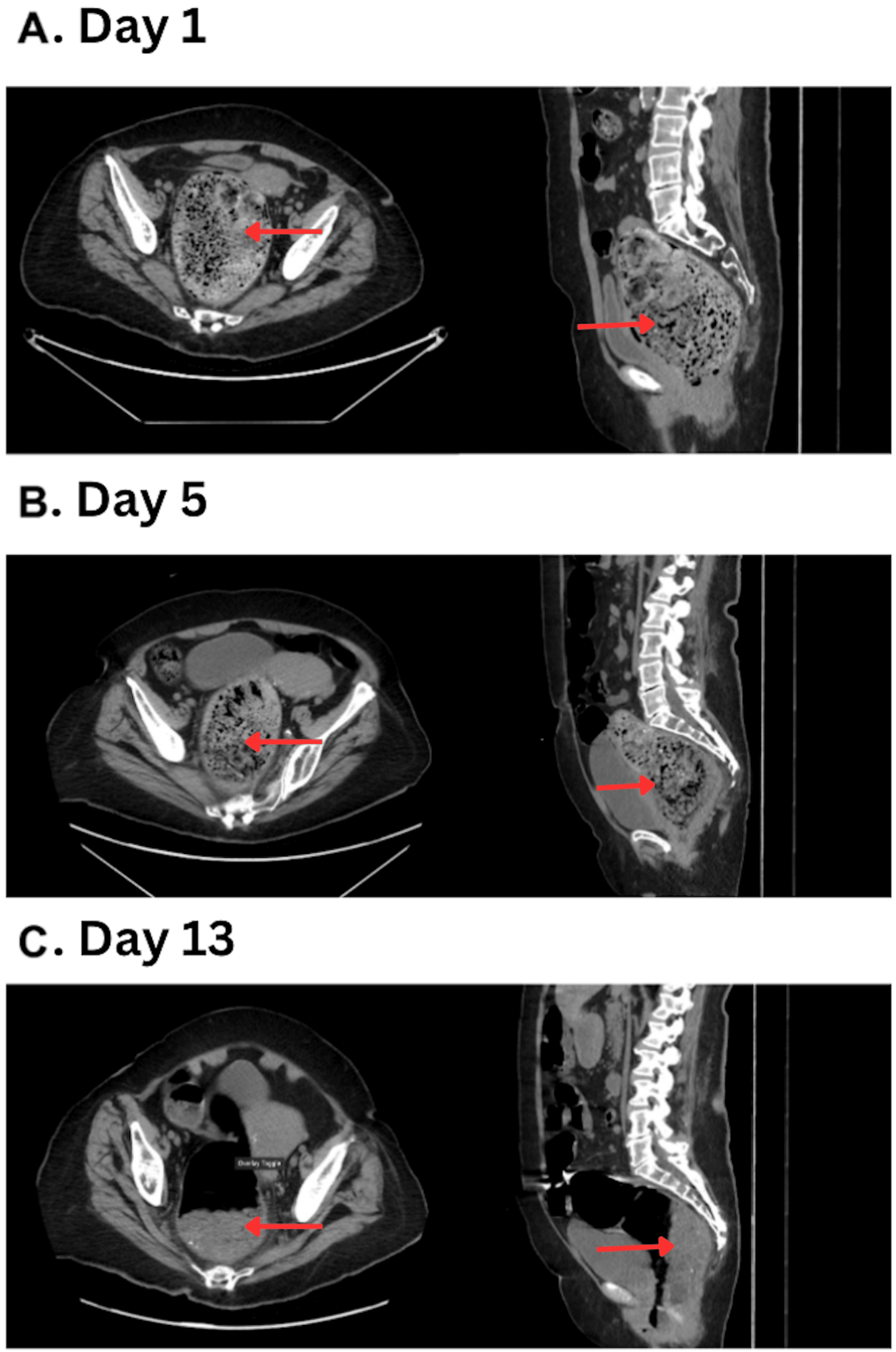 Panel A demonstrates the significant fecal impaction on admission. Panel B indicates fecaloma persistence after conservative measures on hospital day 5. Panel C shows significant reduction in size of the fecaloma one day after administration of a classic Coca-Cola enema. The red arrows indicate stool burden over the hospital course.