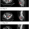 Panel A demonstrates the significant fecal impaction on admission. Panel B indicates fecaloma persistence after conservative measures on hospital day 5. Panel C shows significant reduction in size of the fecaloma one day after administration of a classic Coca-Cola enema. The red arrows indicate stool burden over the hospital course.