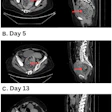 Panel A demonstrates the significant fecal impaction on admission. Panel B indicates fecaloma persistence after conservative measures on hospital day 5. Panel C shows significant reduction in size of the fecaloma one day after administration of a classic Coca-Cola enema. The red arrows indicate stool burden over the hospital course.