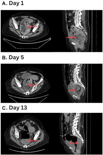 CT reveals new use for Coca-Cola: Dissolving fecalomas