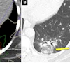 Acute radiation-induced pneumonitis after SBRT (65 Gy, four fractions) in a 53-year-old woman with leiomyosarcoma of the uterus with a left lower lobe metastasis manifesting as a small nodule (not shown). (A) Axial dosimetric reconstruction of a CT image obtained for SBRT planning shows the metastasis receiving the maximal isodose (6500 cGy). (B) Axial CT image obtained 12 months after completion of RT shows focal ground-glass and consolidative opacities confined to the treatment plan (arrow). Note that acute lung injury with SBRT typically manifests later than with conventional RT (i.e., >12 weeks after completion of therapy), and in 25% of patients, the first CT manifestations occur more than one year after completion of RT.