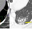 Acute radiation-induced pneumonitis after SBRT (65 Gy, four fractions) in a 53-year-old woman with leiomyosarcoma of the uterus with a left lower lobe metastasis manifesting as a small nodule (not shown). (A) Axial dosimetric reconstruction of a CT image obtained for SBRT planning shows the metastasis receiving the maximal isodose (6500 cGy). (B) Axial CT image obtained 12 months after completion of RT shows focal ground-glass and consolidative opacities confined to the treatment plan (arrow). Note that acute lung injury with SBRT typically manifests later than with conventional RT (i.e., >12 weeks after completion of therapy), and in 25% of patients, the first CT manifestations occur more than one year after completion of RT.