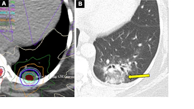 Acute radiation-induced pneumonitis after SBRT (65 Gy, four fractions) in a 53-year-old woman with leiomyosarcoma of the uterus with a left lower lobe metastasis manifesting as a small nodule (not shown). (A) Axial dosimetric reconstruction of a CT image obtained for SBRT planning shows the metastasis receiving the maximal isodose (6500 cGy). (B) Axial CT image obtained 12 months after completion of RT shows focal ground-glass and consolidative opacities confined to the treatment plan (arrow). Note that acute lung injury with SBRT typically manifests later than with conventional RT (i.e., >12 weeks after completion of therapy), and in 25% of patients, the first CT manifestations occur more than one year after completion of RT.