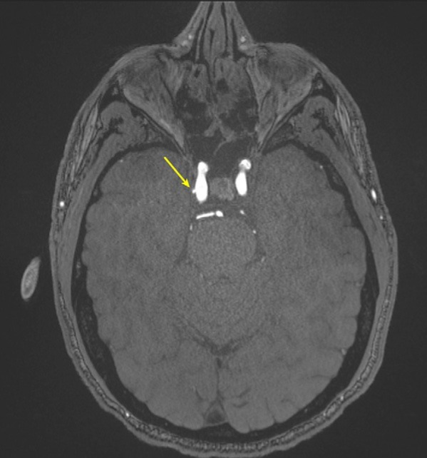 Representative axial time-of-flight MR angiography image in a 39-year-old male participant shows a laterally projecting intracranial aneurysm (arrow) originating from the right cavernous segment of the internal carotid artery.