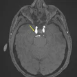 Representative axial time-of-flight MR angiography image in a 39-year-old male participant shows a laterally projecting intracranial aneurysm (arrow) originating from the right cavernous segment of the internal carotid artery.