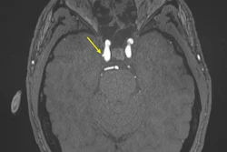 Representative axial time-of-flight MR angiography image in a 39-year-old male participant shows a laterally projecting intracranial aneurysm (arrow) originating from the right cavernous segment of the internal carotid artery.