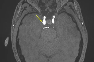 Representative axial time-of-flight MR angiography image in a 39-year-old male participant shows a laterally projecting intracranial aneurysm (arrow) originating from the right cavernous segment of the internal carotid artery.