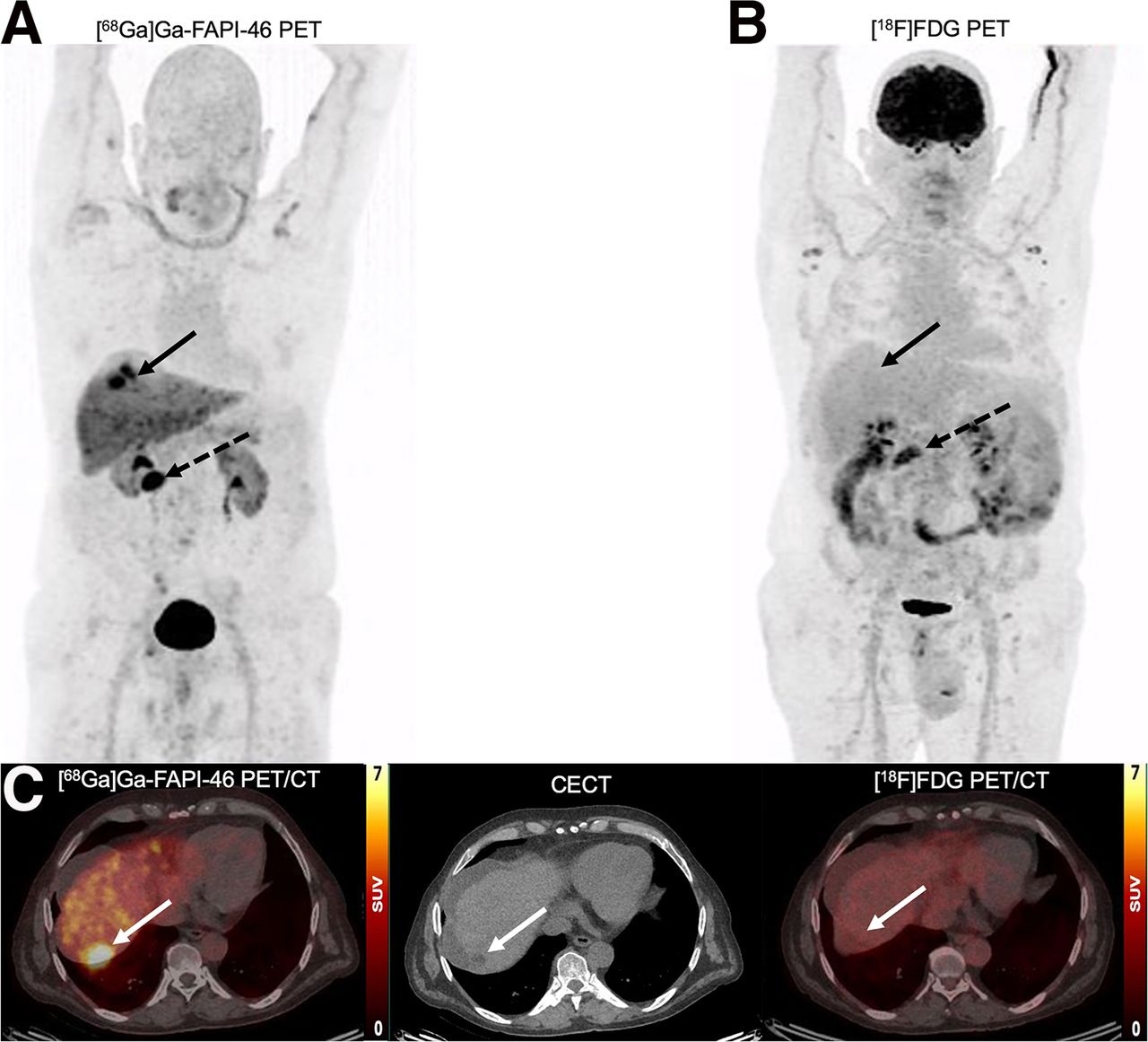 A 65-y-old man with HCC and liver cirrhosis confirmed by MRI. Ga-68 FAPI-46 PET/CT demonstrates increased focal uptake (SUVmax, 13.26, and TBRmax, 2.89) in liver, whereas F-18 FDG-PET/CT scans showed non&ndash;F-18 FDG-avid lesion (SUVmax, 3.24, and TBRmax, 1.43), indicated by solid arrows. Additionally, histologically proven adenocarcinoma in colon transversum was identified as pathologic with Ga-68 FAPI-46 alone (dashed arrows).