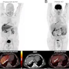 A 65-y-old man with HCC and liver cirrhosis confirmed by MRI. Ga-68 FAPI-46 PET/CT demonstrates increased focal uptake (SUVmax, 13.26, and TBRmax, 2.89) in liver, whereas F-18 FDG-PET/CT scans showed non–F-18 FDG-avid lesion (SUVmax, 3.24, and TBRmax, 1.43), indicated by solid arrows. Additionally, histologically proven adenocarcinoma in colon transversum was identified as pathologic with Ga-68 FAPI-46 alone (dashed arrows).