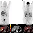 A 65-y-old man with HCC and liver cirrhosis confirmed by MRI. Ga-68 FAPI-46 PET/CT demonstrates increased focal uptake (SUVmax, 13.26, and TBRmax, 2.89) in liver, whereas F-18 FDG-PET/CT scans showed non–F-18 FDG-avid lesion (SUVmax, 3.24, and TBRmax, 1.43), indicated by solid arrows. Additionally, histologically proven adenocarcinoma in colon transversum was identified as pathologic with Ga-68 FAPI-46 alone (dashed arrows).