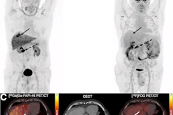 A 65-y-old man with HCC and liver cirrhosis confirmed by MRI. Ga-68 FAPI-46 PET/CT demonstrates increased focal uptake (SUVmax, 13.26, and TBRmax, 2.89) in liver, whereas F-18 FDG-PET/CT scans showed non–F-18 FDG-avid lesion (SUVmax, 3.24, and TBRmax, 1.43), indicated by solid arrows. Additionally, histologically proven adenocarcinoma in colon transversum was identified as pathologic with Ga-68 FAPI-46 alone (dashed arrows).