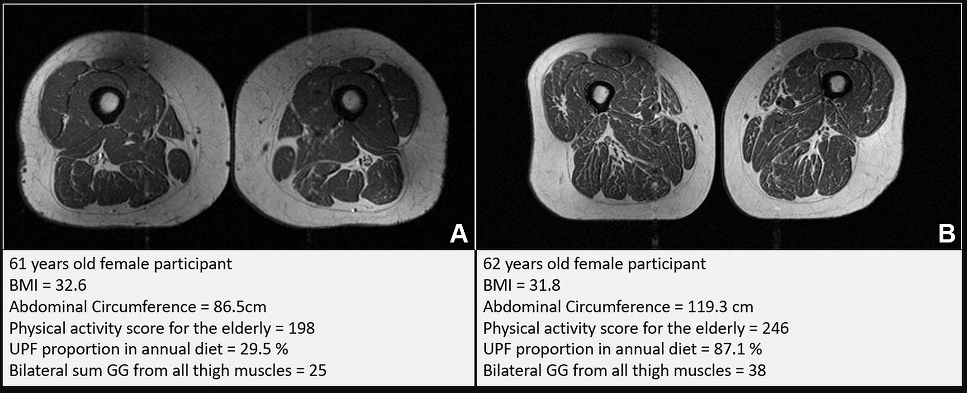 Representative axial T1-weighted spin-echo thigh MRI scans in (A) a 61-year-old female participant and (B) a 62-year-old female participant. Both participants were of similar age and body mass index (BMI, calculated as weight in kilograms divided by height in meters squared). Both had Physical Activity Scale for the Elderly scores above the mean score in the study. According to the World Health Organization definition, the participant in B qualified as having abdominal obesity (abdominal circumference &ge; 88 cm). Abdominal circumference is a measure of central obesity that captures fat distribution and serves as an indicator of cardiometabolic health. Compared with the participant in A, the participant in B had a higher proportion of ultra-processed food (UPF) in their diet (87.1% vs 29.5%) and exhibited fattier thigh muscles bilaterally, with Goutallier grade (GG) for all thigh muscles summing to 25 for the participant in A and 38 for the participant in B.