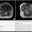 Representative axial T1-weighted spin-echo thigh MRI scans in (A) a 61-year-old female participant and (B) a 62-year-old female participant. Both participants were of similar age and body mass index (BMI, calculated as weight in kilograms divided by height in meters squared). Both had Physical Activity Scale for the Elderly scores above the mean score in the study. According to the World Health Organization definition, the participant in B qualified as having abdominal obesity (abdominal circumference ≥ 88 cm). Abdominal circumference is a measure of central obesity that captures fat distribution and serves as an indicator of cardiometabolic health. Compared with the participant in A, the participant in B had a higher proportion of ultra-processed food (UPF) in their diet (87.1% vs 29.5%) and exhibited fattier thigh muscles bilaterally, with Goutallier grade (GG) for all thigh muscles summing to 25 for the participant in A and 38 for the participant in B.